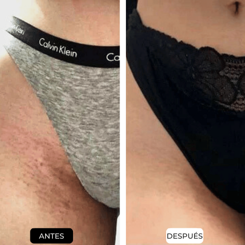 Depiladora Laser IPL | Elyse