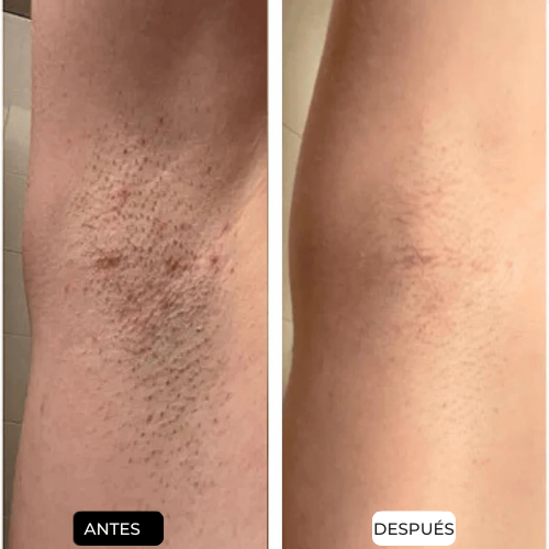 Depiladora Laser IPL | Elyse