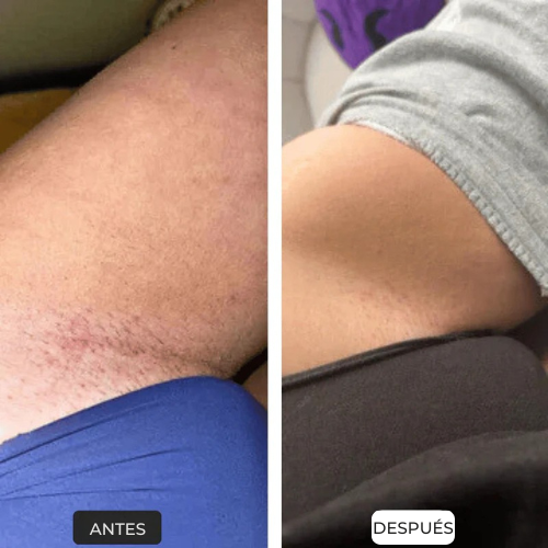 Depiladora Laser IPL | Elyse